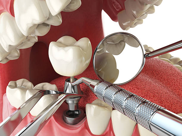 Best Dental Abscess Treatment in Rio Hondo, TX